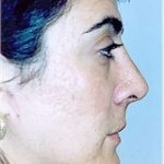 Rhinoplasty Before & After Patient #1558