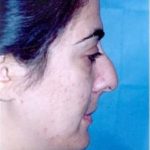 Rhinoplasty Before & After Patient #1558