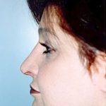 Rhinoplasty Before & After Patient #1557