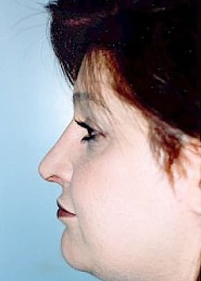 Rhinoplasty Before & After Patient #1557