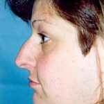 Rhinoplasty Before & After Patient #1557