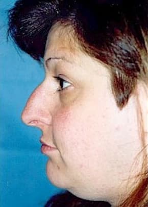 Rhinoplasty Before & After Patient #1557