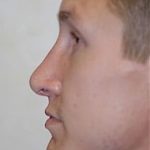 Rhinoplasty Before & After Patient #1556