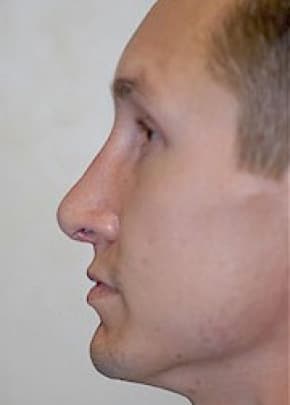 Rhinoplasty Before & After Patient #1556