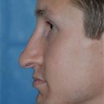 Rhinoplasty Before & After Patient #1556
