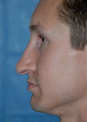Rhinoplasty Before & After Patient #1556