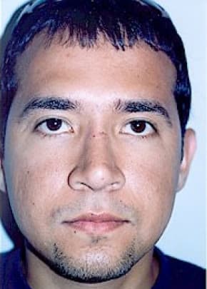 Rhinoplasty Before & After Patient #1555