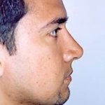 Rhinoplasty Before & After Patient #1555