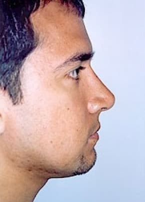 Rhinoplasty Before & After Patient #1555