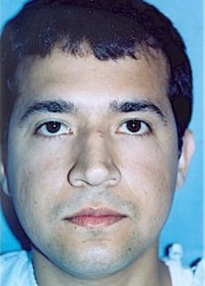 Rhinoplasty Before & After Patient #1555