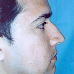 Rhinoplasty Before & After Patient #1555