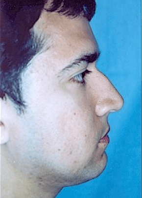 Rhinoplasty Before & After Patient #1555