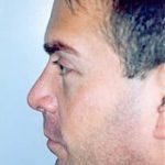 Rhinoplasty Before & After Patient #1554