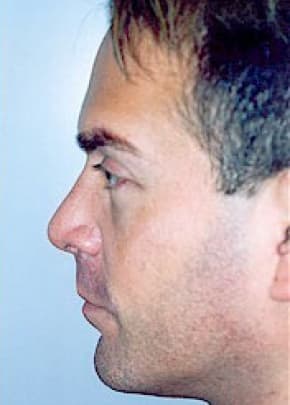 Rhinoplasty Before & After Patient #1554