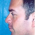 Rhinoplasty Before & After Patient #1554