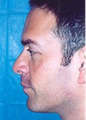 Rhinoplasty Before & After Patient #1554