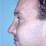 Rhinoplasty Before & After Patient #1553