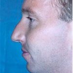 Rhinoplasty Before & After Patient #1553
