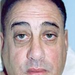 Rhinoplasty Before & After Patient #1552