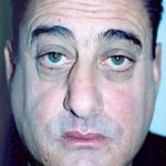 Rhinoplasty Before & After Patient #1552