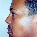 Rhinoplasty Before & After Patient #1551