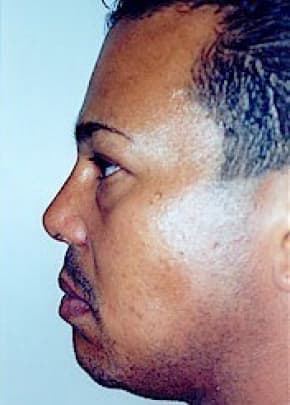 Rhinoplasty Before & After Patient #1551