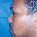 Rhinoplasty Before & After Patient #1551