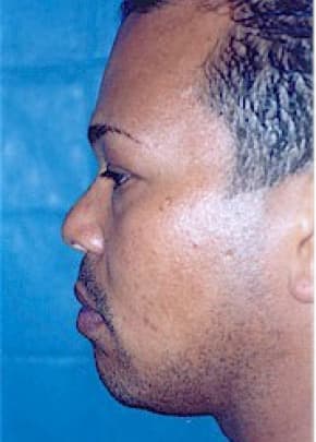 Rhinoplasty Before & After Patient #1551