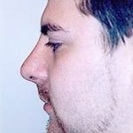 Rhinoplasty Before & After Patient #1550