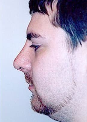 Rhinoplasty Before & After Patient #1550