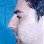 Rhinoplasty Before & After Patient #1550