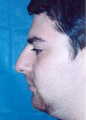 Rhinoplasty Before & After Patient #1550