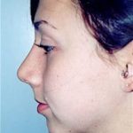 Rhinoplasty Before & After Patient #1549