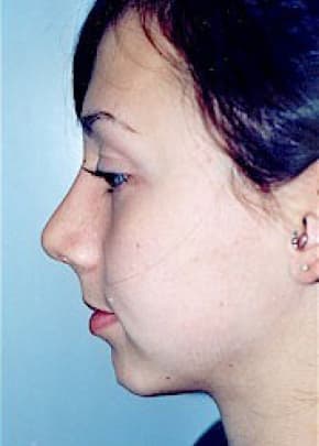 Rhinoplasty Before & After Patient #1549