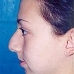 Rhinoplasty Before & After Patient #1549