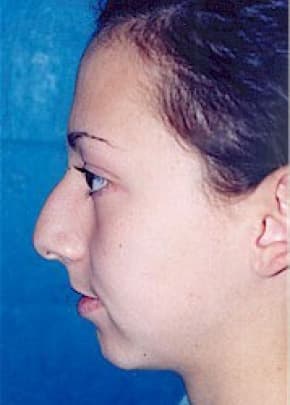 Rhinoplasty Before & After Patient #1549