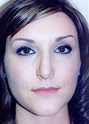Rhinoplasty Before & After Patient #1548