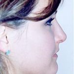 Rhinoplasty Before & After Patient #1548