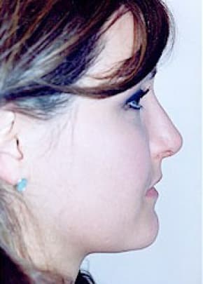 Rhinoplasty Before & After Patient #1548