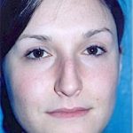 Rhinoplasty Before & After Patient #1548