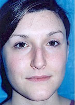 Rhinoplasty Before & After Patient #1548