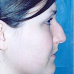 Rhinoplasty Before & After Patient #1548