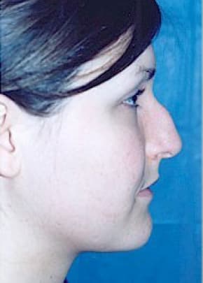 Rhinoplasty Before & After Patient #1548