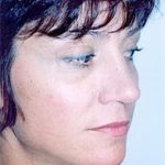 Rhinoplasty Before & After Patient #1547
