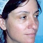 Rhinoplasty Before & After Patient #1547