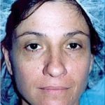 Rhinoplasty Before & After Patient #1547
