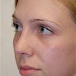 Rhinoplasty Before & After Patient #1546
