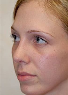 Rhinoplasty Before & After Patient #1546