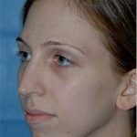 Rhinoplasty Before & After Patient #1546