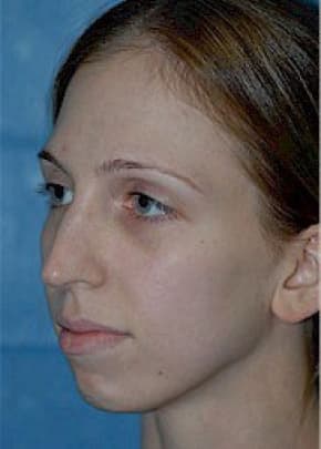 Rhinoplasty Before & After Patient #1546